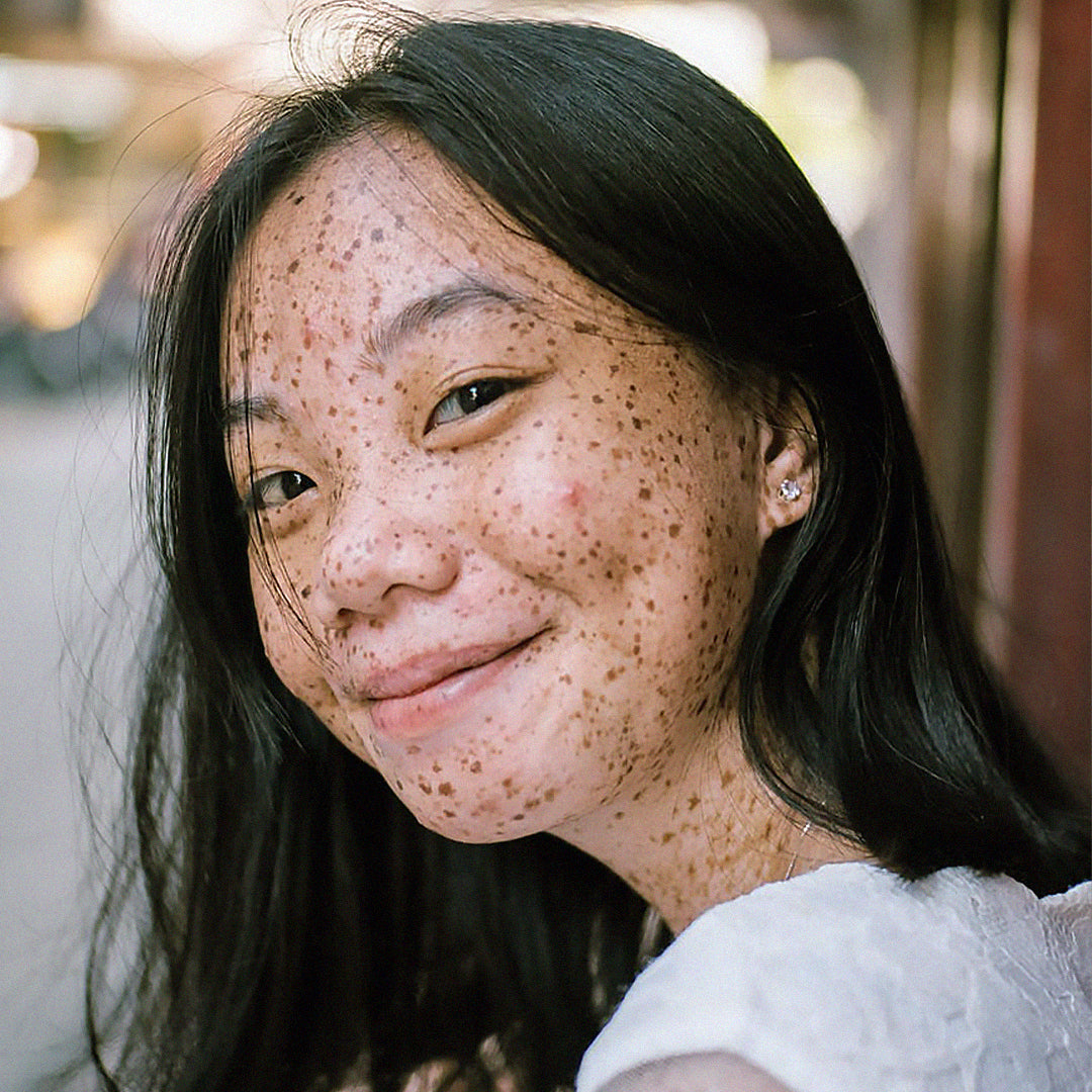 Pourquoi a t-on de l'acné hormonale ?