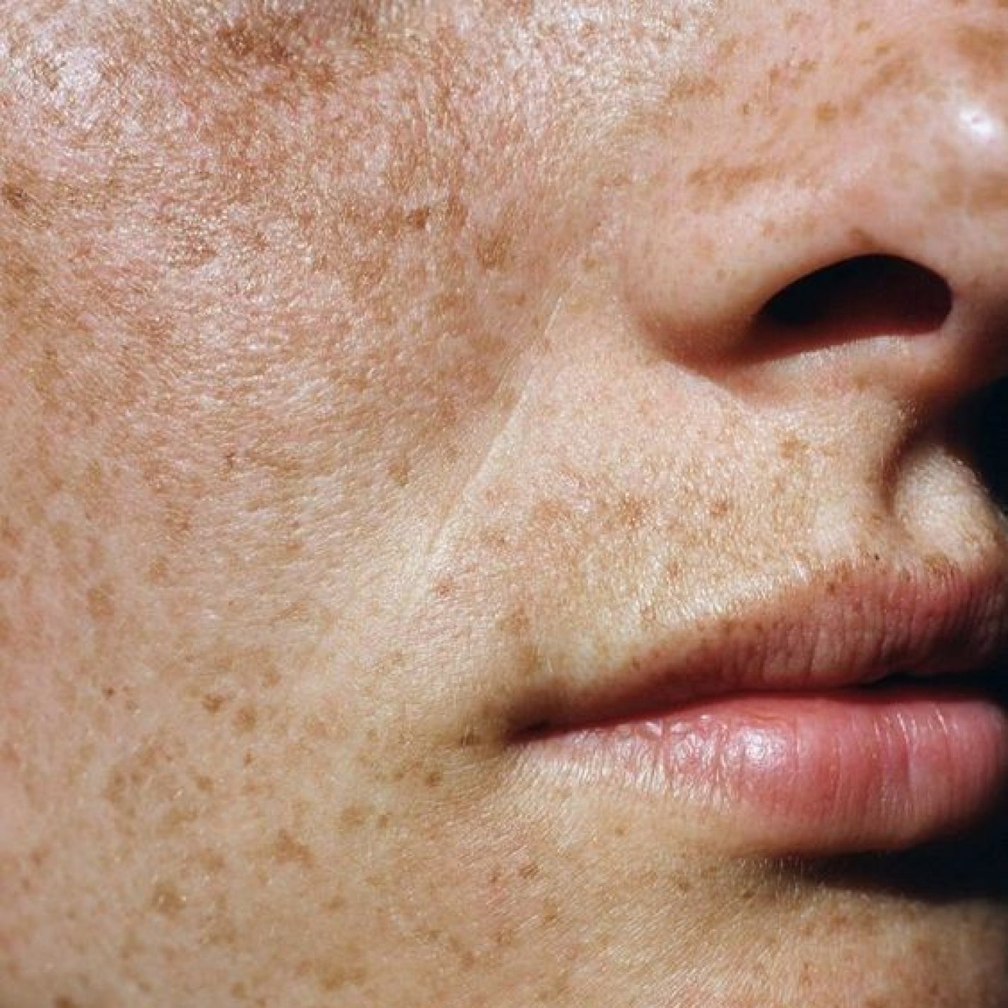 Adieu aux taches brunes : comprendre, prévenir et traiter