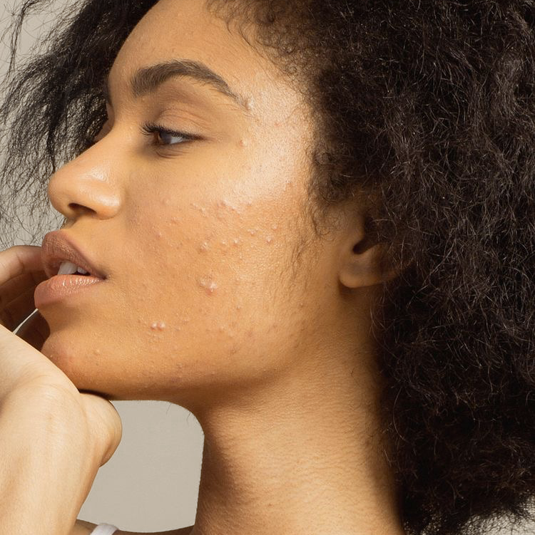 Comment enlever les imperfection de la peau ? - HOLITE